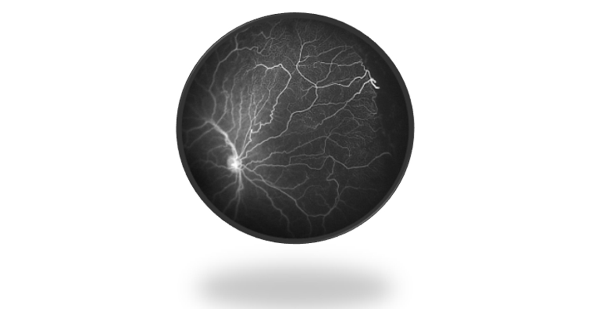 What is Fluorescein Angiography? Vision Care ACADEMY